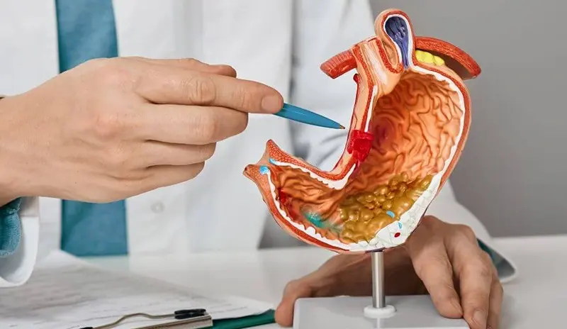 gastric cancer foto