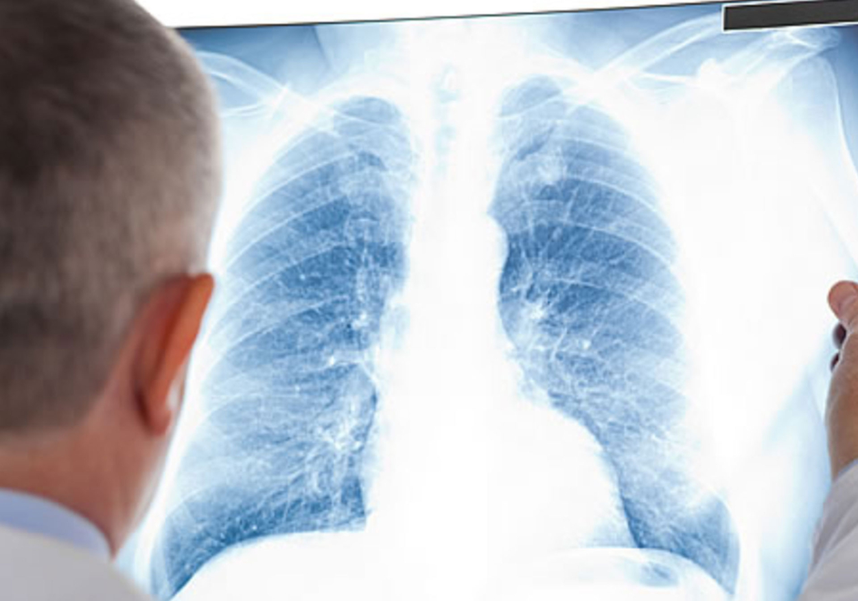 lung cancer new photo