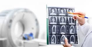lung cancer photo new